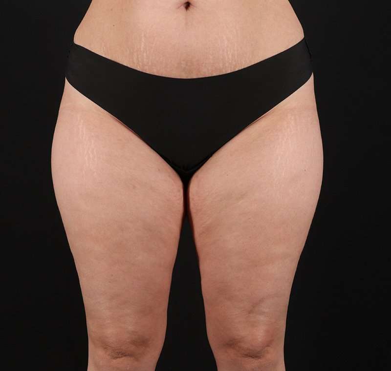 Liposuction Before & After Patient #1249