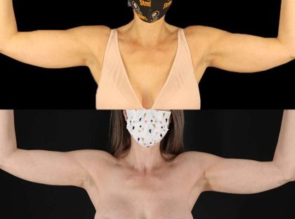 Liposuction Before & After Patient #1256