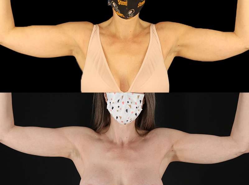 Liposuction Before & After Patient #1256