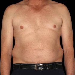 Liposuction Before & After Patient #1270