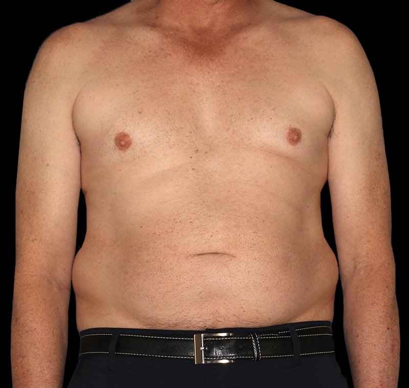 Liposuction Before & After Patient #1270