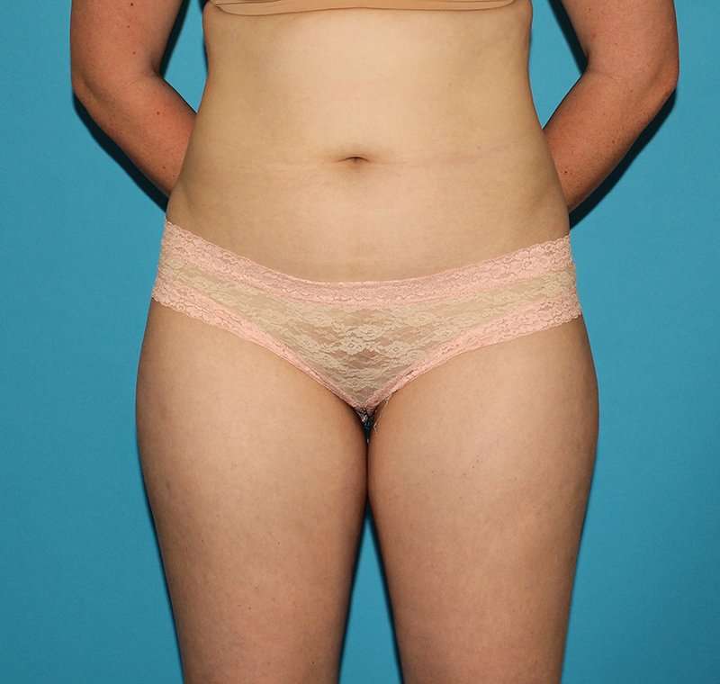 Liposuction Before & After Patient #1281
