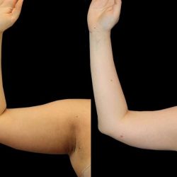 Liposuction Before & After Patient #1284
