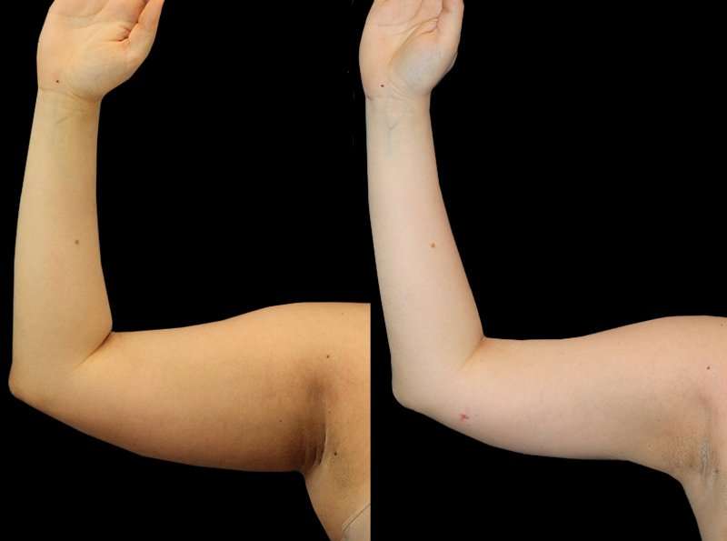 Liposuction Before & After Patient #1284