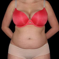 Liposuction Before & After Patient #1298
