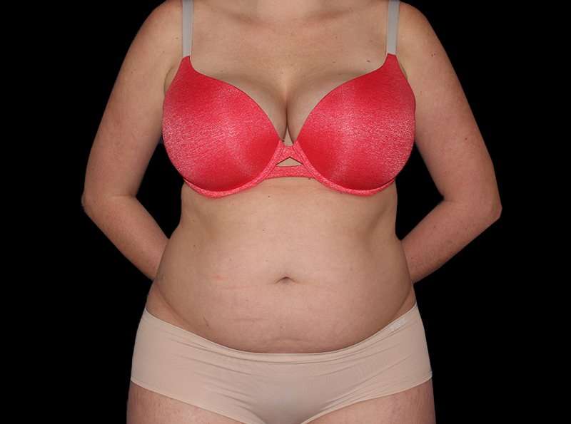 Liposuction Before & After Patient #1298