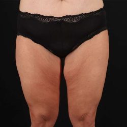 Liposuction Before & After Patient #1337