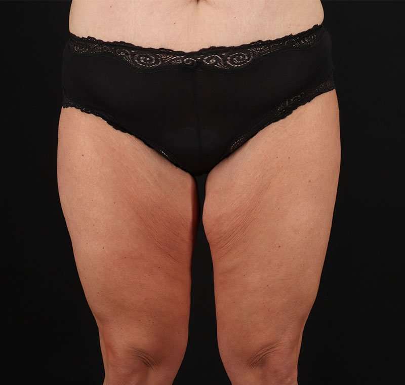 Liposuction Before & After Patient #1337