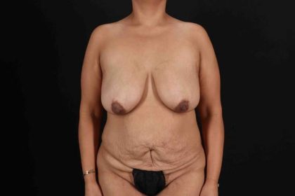 Liposuction Before & After Patient #1403