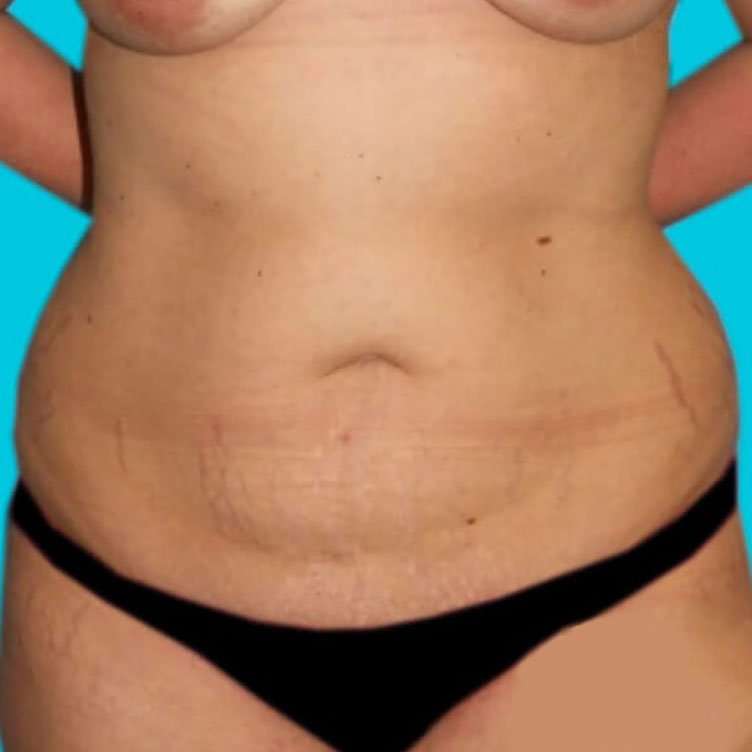 Liposuction Before & After Patient #1410