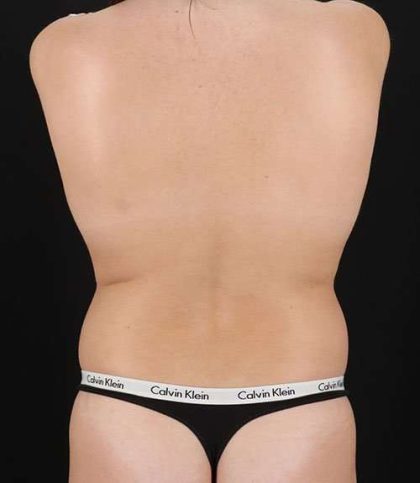 Liposuction Before & After Patient #1414