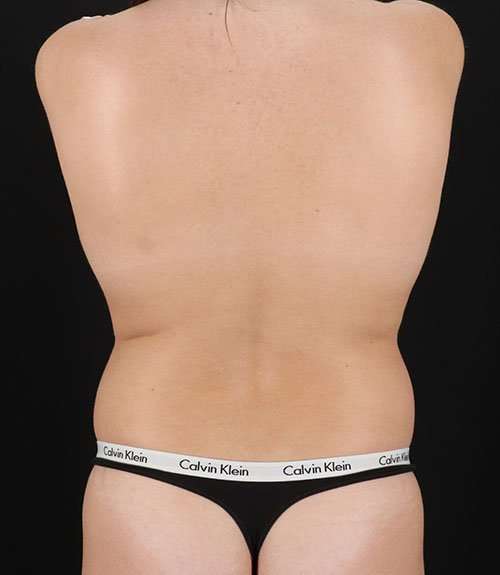 Liposuction Before & After Patient #1414