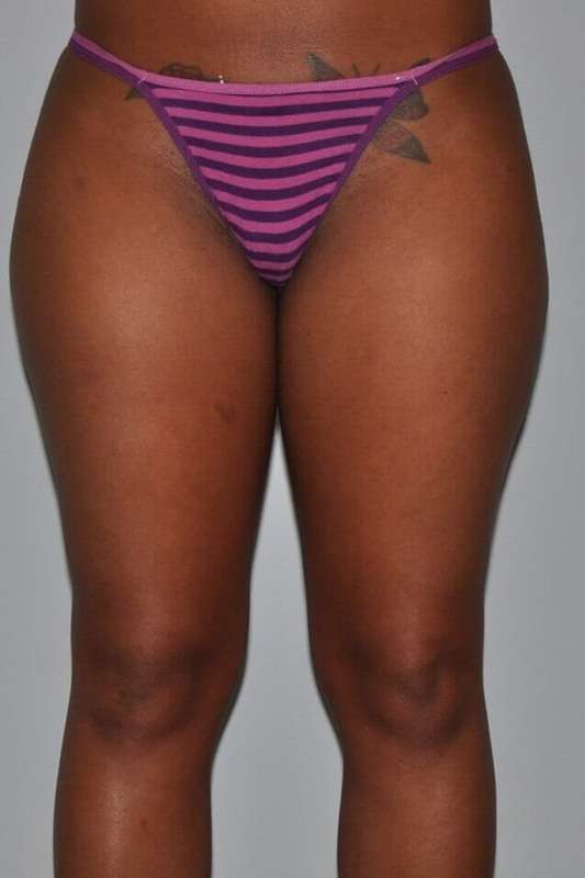 Liposuction Before & After Patient #1419