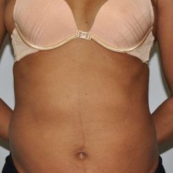 Liposuction Before & After Patient #1425