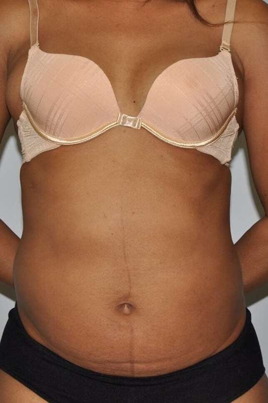 Liposuction Before & After Patient #1425