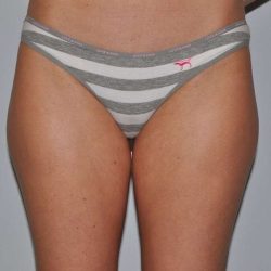 Liposuction Before & After Patient #1428