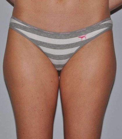 Liposuction Before & After Patient #1428