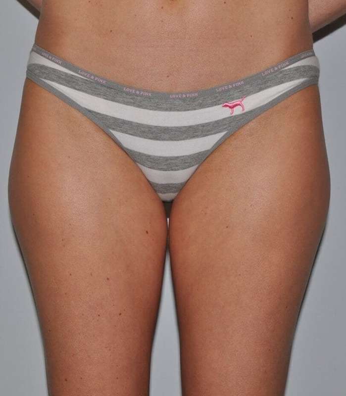 Liposuction Before & After Patient #1428