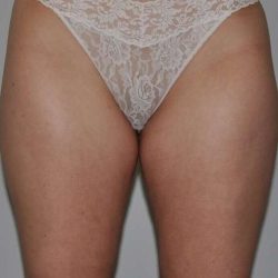 Liposuction Before & After Patient #1433
