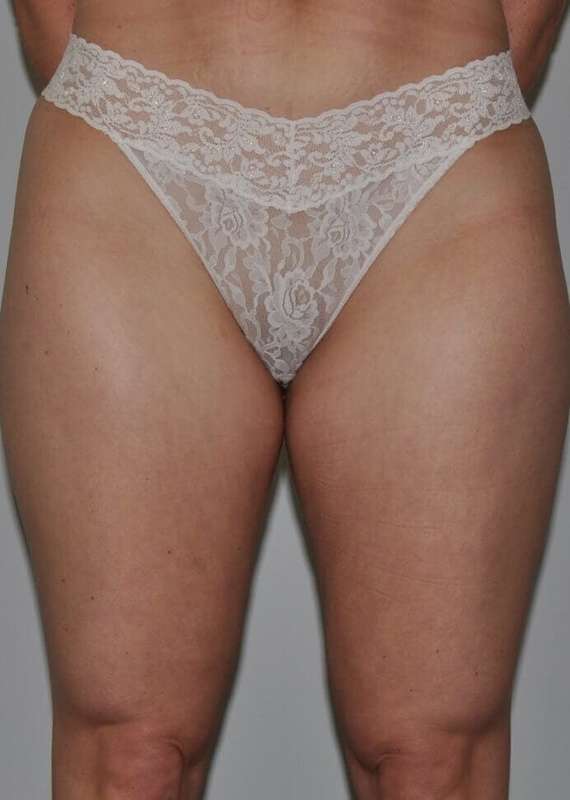 Liposuction Before & After Patient #1433