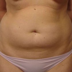 Liposuction Before & After Patient #1439