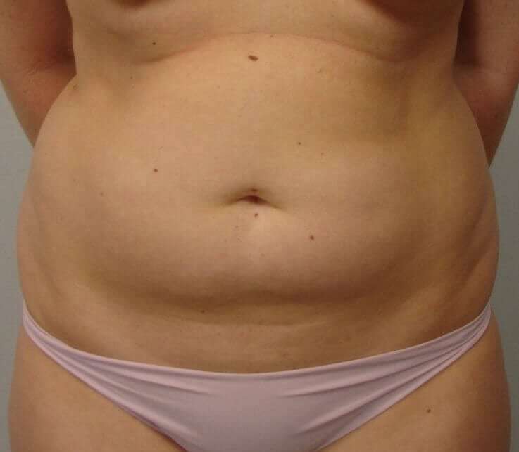 Liposuction Before & After Patient #1439