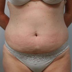 Liposuction Before & After Patient #1445