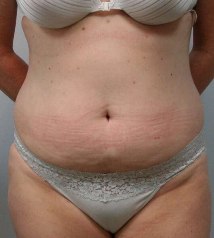 Liposuction Before & After Patient #1445
