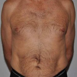Liposuction Before & After Patient #1450