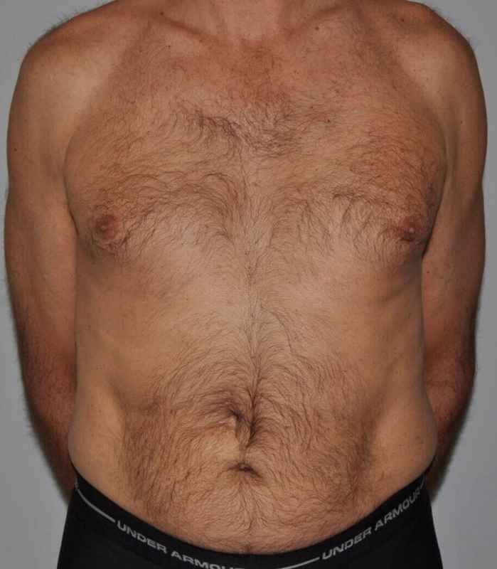 Liposuction Before & After Patient #1450