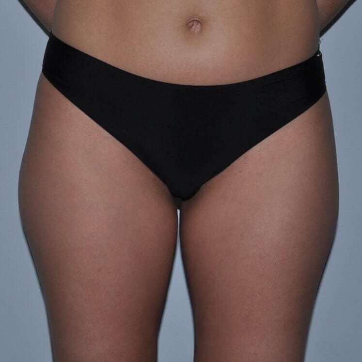 Liposuction Before & After Patient #1455