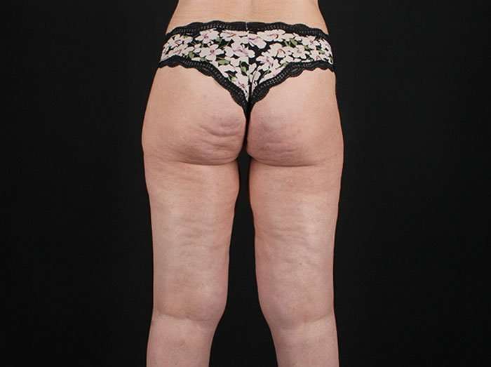 Cellulite Treatment Before & After Patient #546