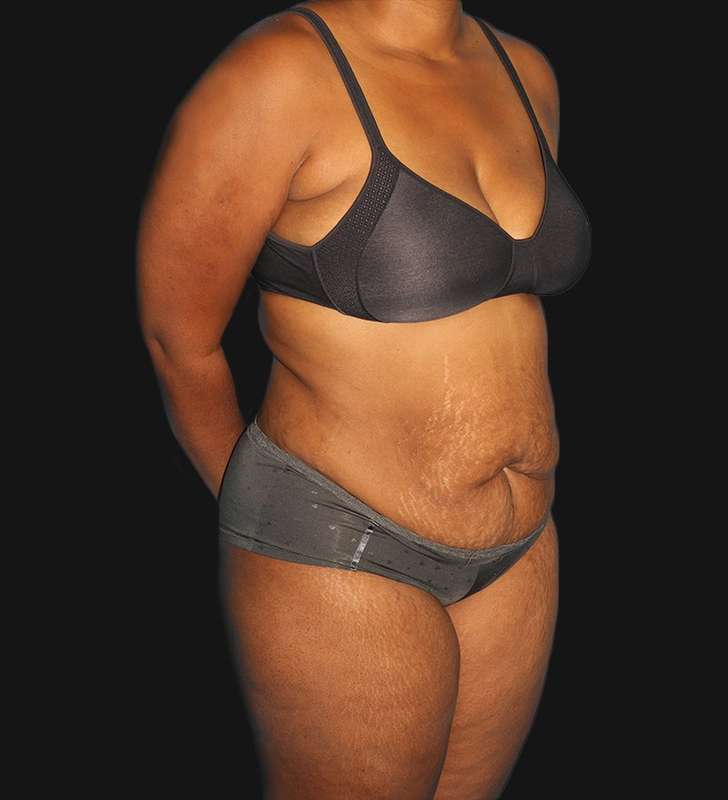 Abdominoplasty (Tummy Tuck) Before & After Patient #568