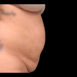 Abdominoplasty (Tummy Tuck) Before & After Patient #670