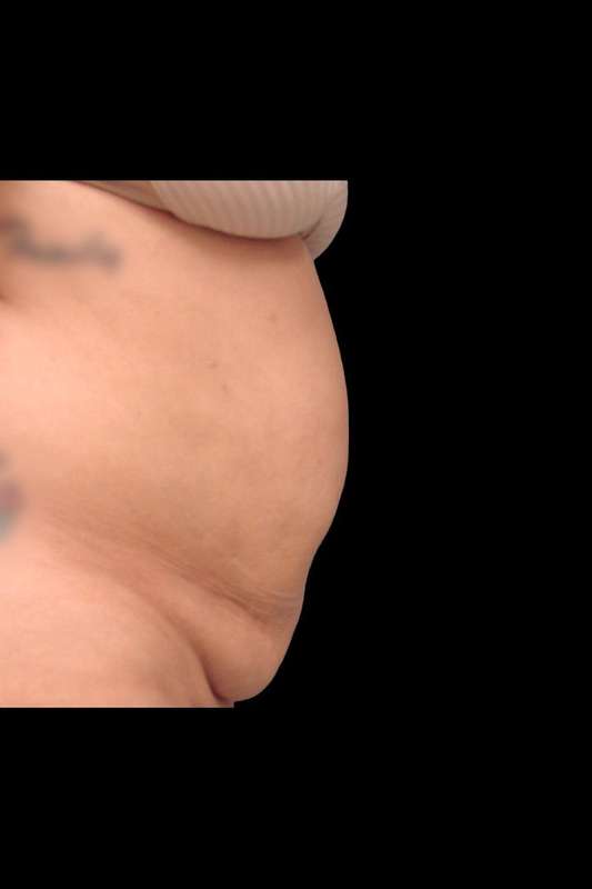 Abdominoplasty (Tummy Tuck) Before & After Patient #670