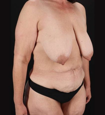 Mommy Makeover Before & After Patient #1713