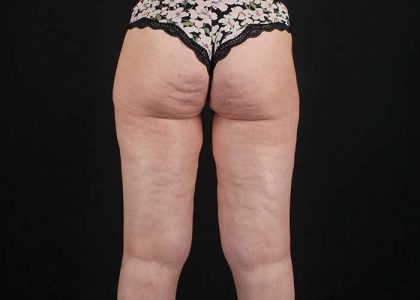 Thigh Lift Before & After Patient #1756