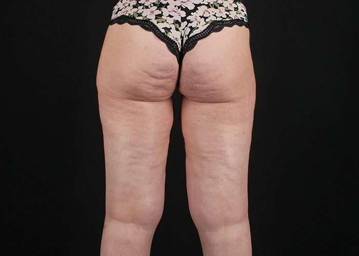 Thigh Lift Before & After Patient #1756