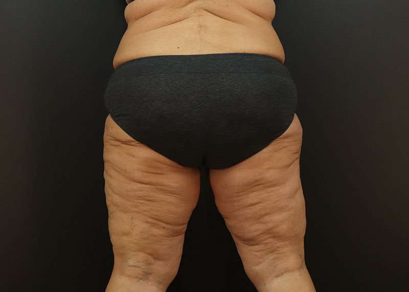 Thigh Lift Before & After Patient #1762