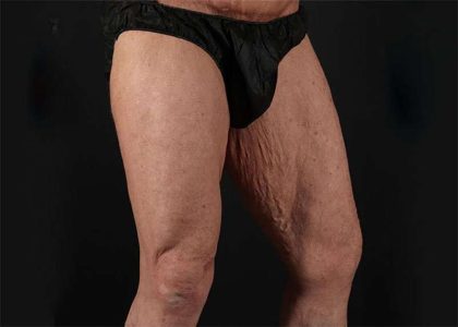 Thigh Lift Before & After Patient #1776