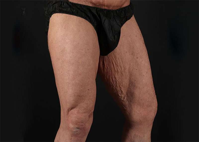 Thigh Lift Before & After Patient #1776