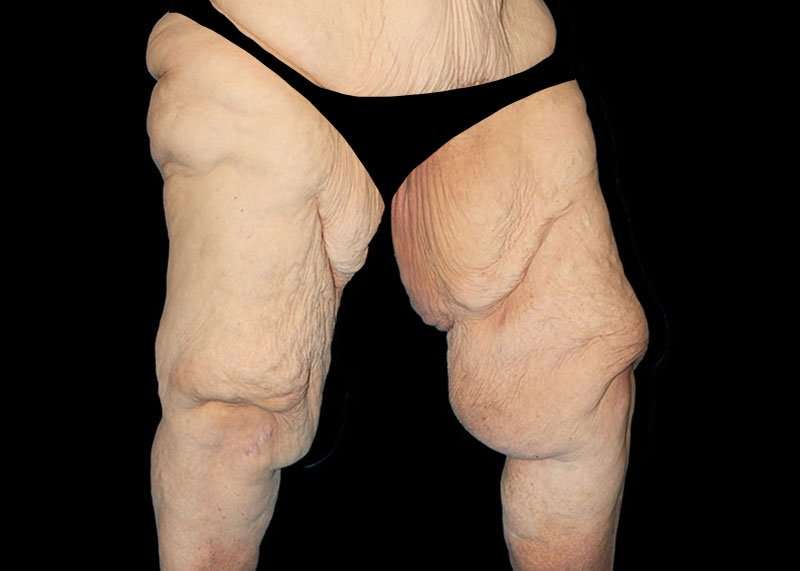 Thigh Lift Before & After Patient #1790