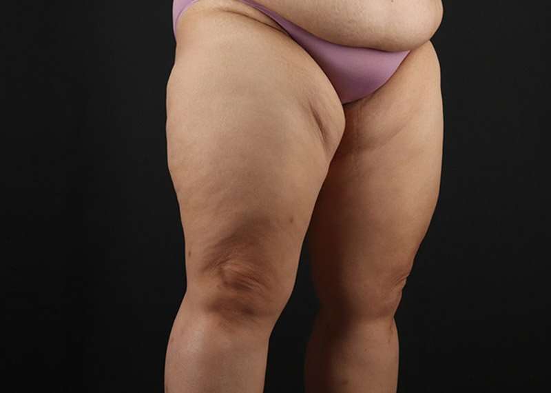 Thigh Lift Before & After Patient #1804