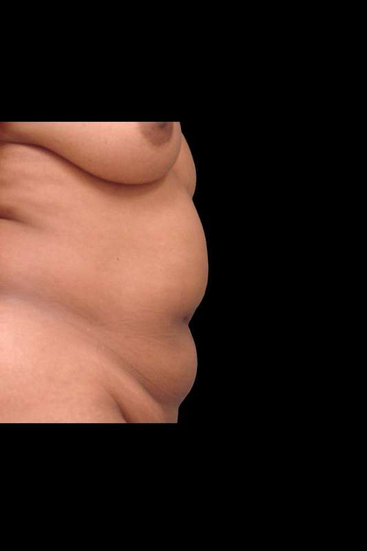 Abdominoplasty (Tummy Tuck) Before & After Patient #675