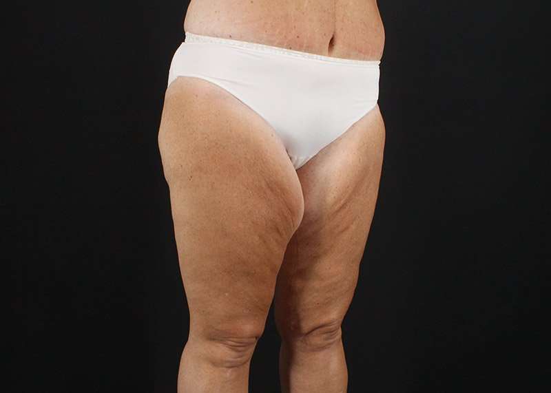 Thigh Lift Before & After Patient #1818