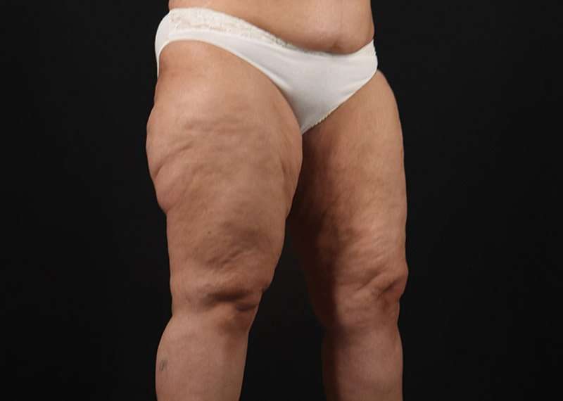 Thigh Lift Before & After Patient #1831