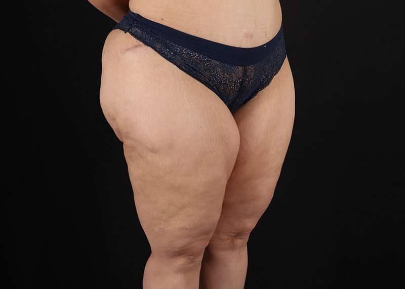 Thigh Lift Before & After Patient #1844