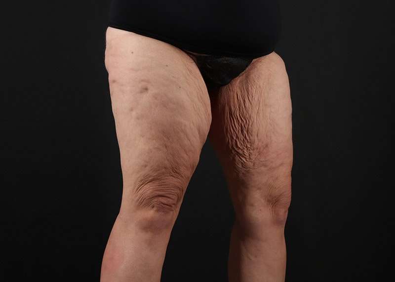 Thigh Lift Before & After Patient #1857