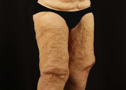 Thigh Lift Before & After Patient #1871