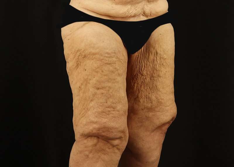 Thigh Lift Before & After Patient #1871